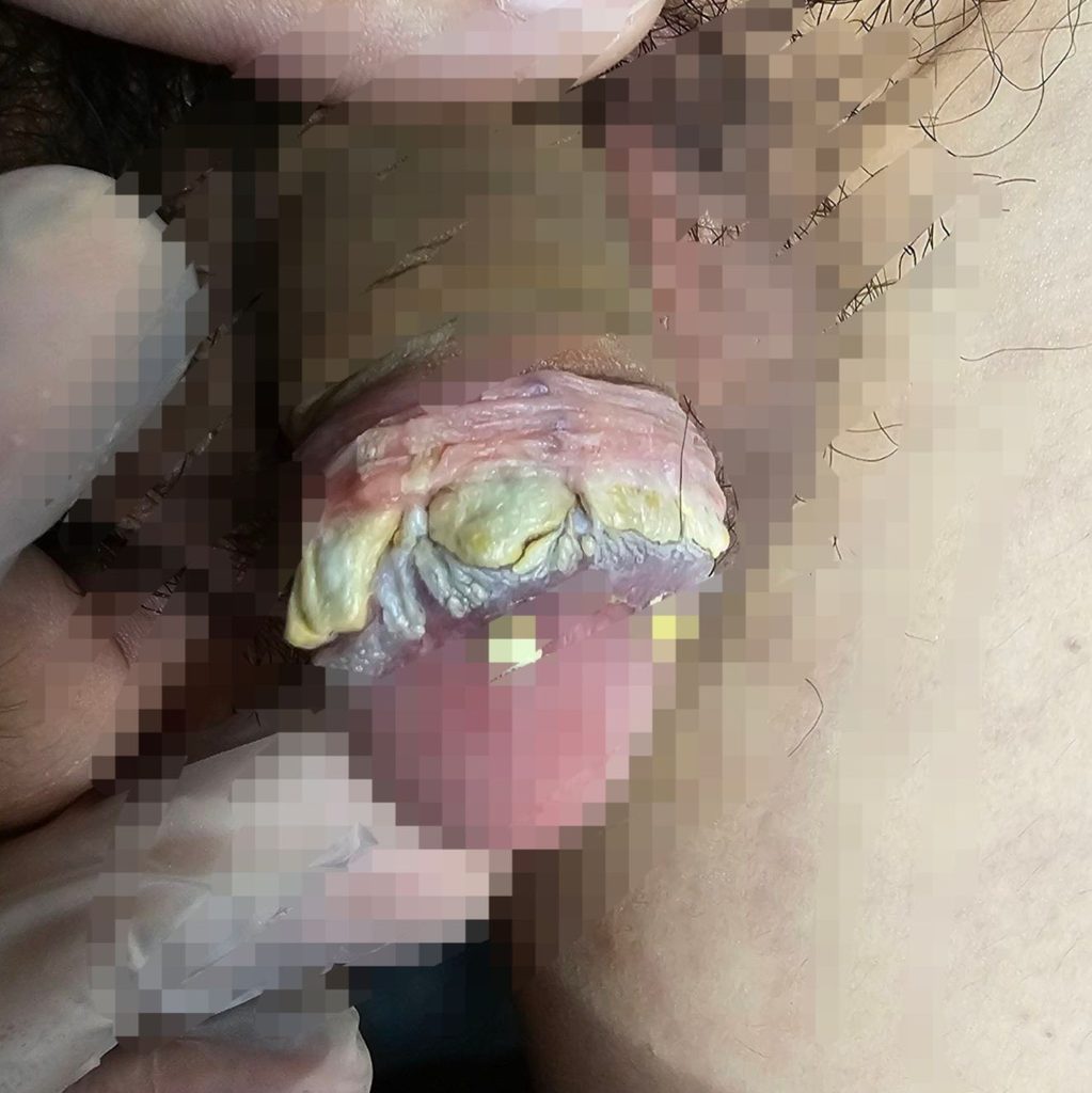 包皮垢